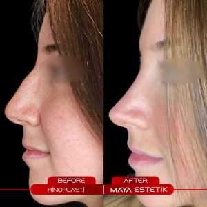 Rhinoplasty Before After 2
