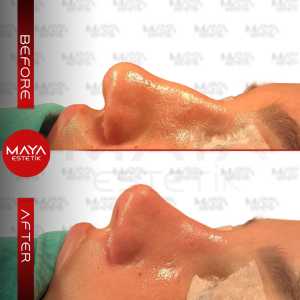 Rhinoplasty Before After 4