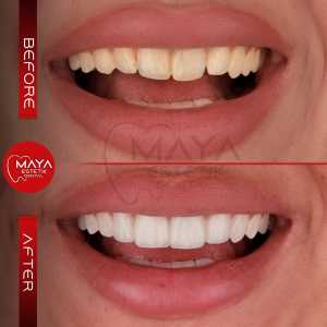 Teeth Whitening Before After 1