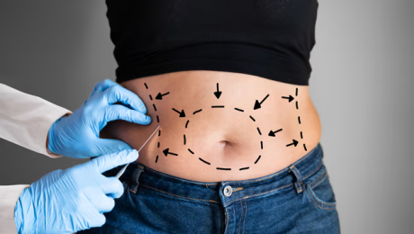 Liposuction Sonrası İyileşme Süreci