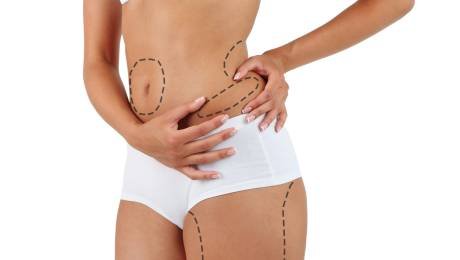 Liposuction Kimler İçin Uygundur?