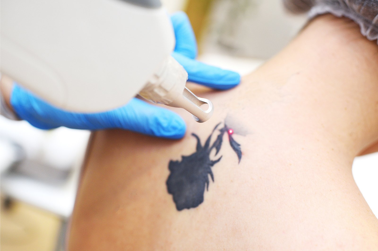 Pico Laser Tattoo Removal