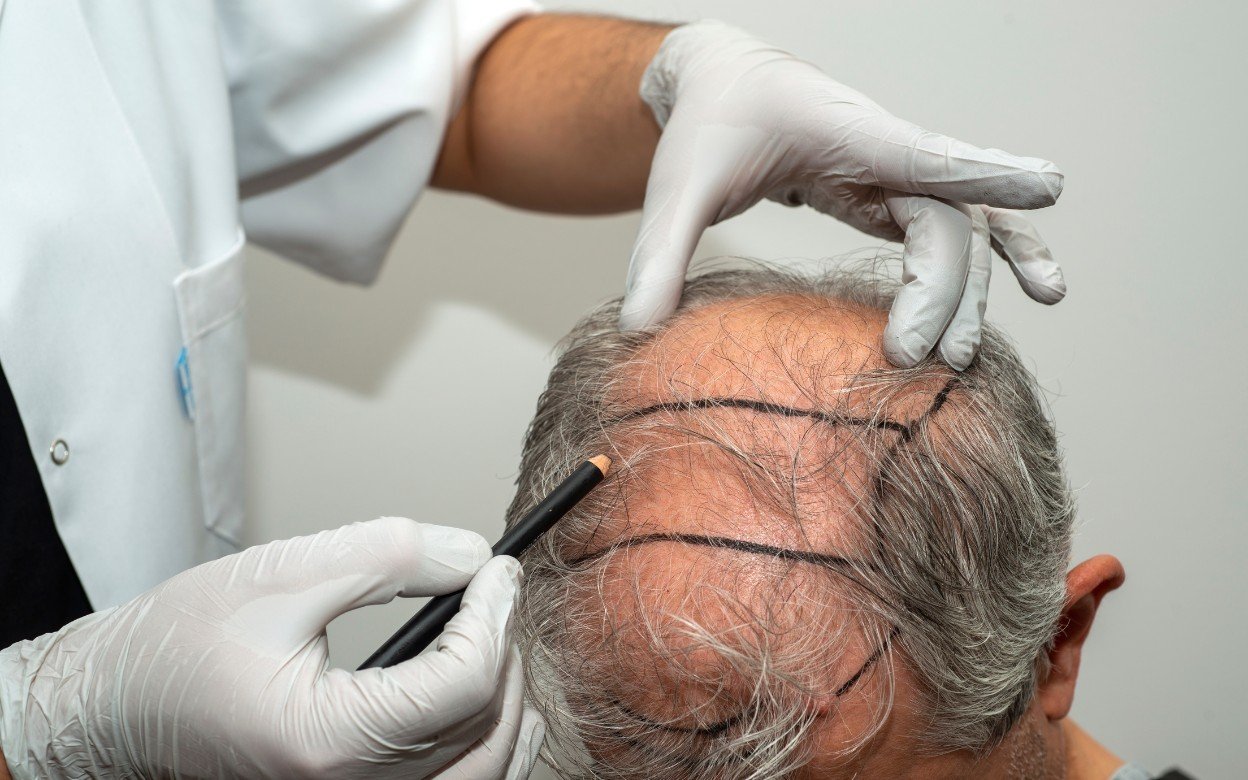 FUE Hair Transplant