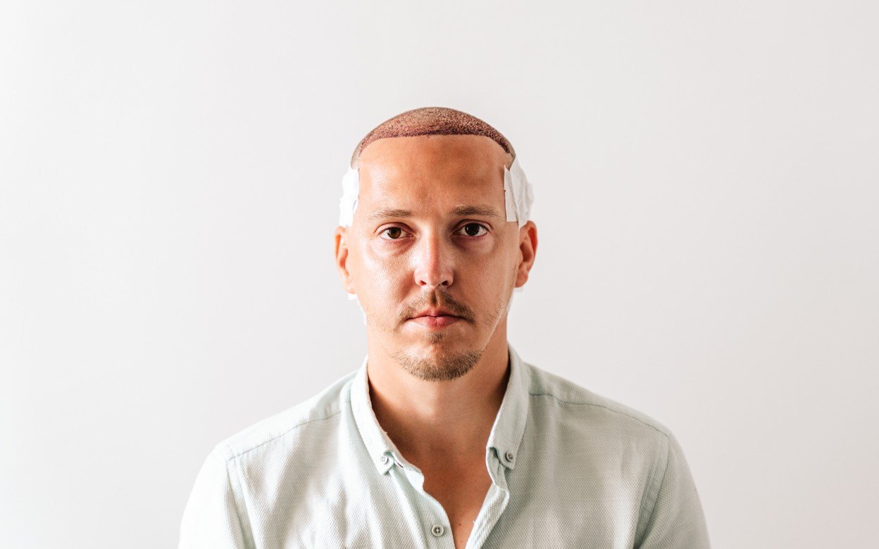 زراعة الشعر مع التخدير