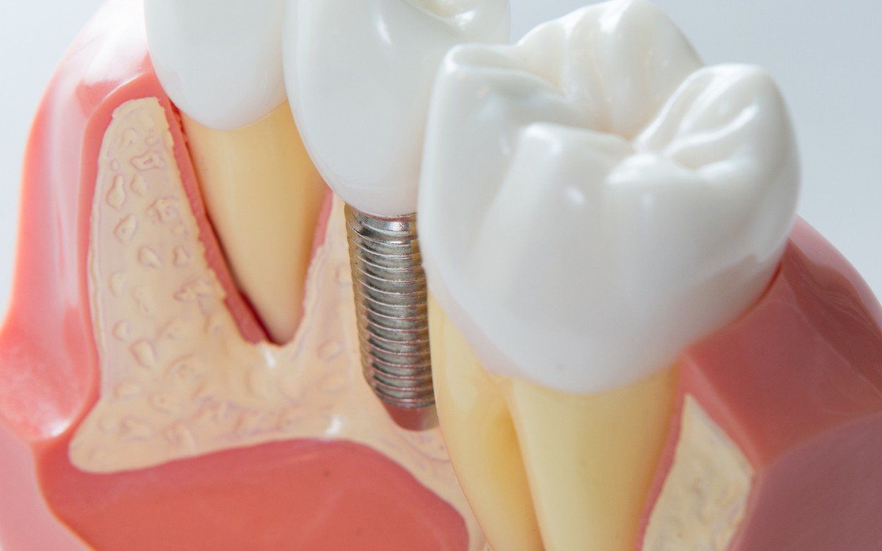 Dental Implants