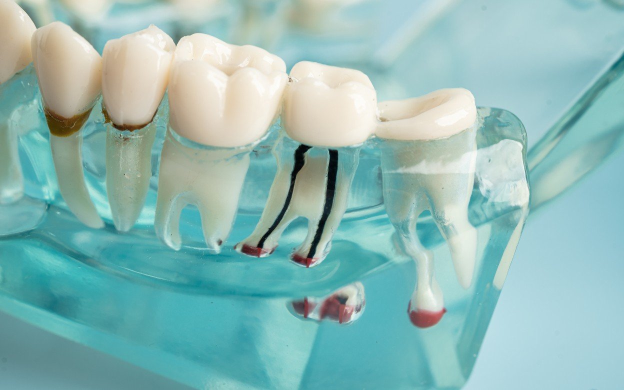Root Canal Treatment
