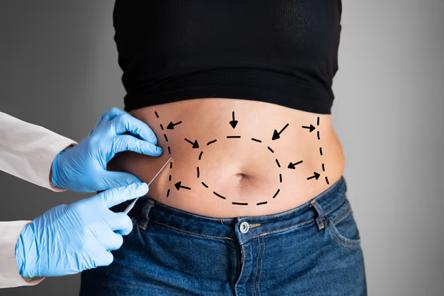 Liposuction (Yağ Aldırma Ameliyatı)